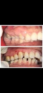 cost of tooth veneers Not Resulting In Financial Prosperity