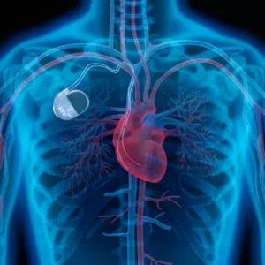 PACEMAKER